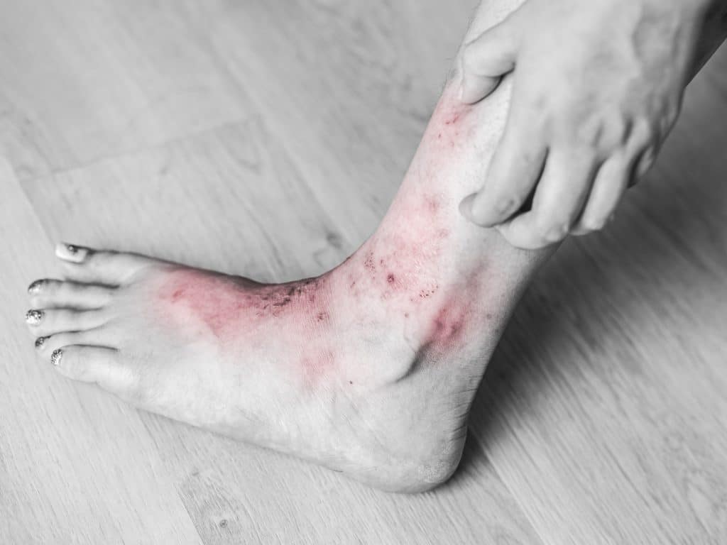 Juckende Füße bei Neurodermitis und Psoriasis